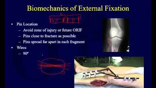 Orthopaedic Implants 2  External Fixation [upl. by Tenneb680]