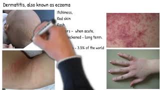 Dermatitis vs Eczema are they same Types of dermatitis symptoms prognosis and treatment [upl. by Nanfa]