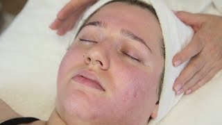 Facial Scarring Refinements The Lactic Peel [upl. by Ivory]