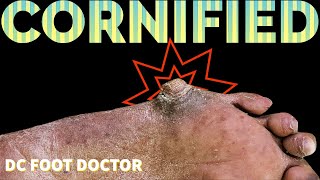 Cornified Extremely Thick and Hard Callus Removal [upl. by Pretrice]