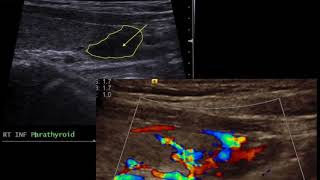 TMT Neck Ultrasound Parathyroid Nodule [upl. by Dabbs819]