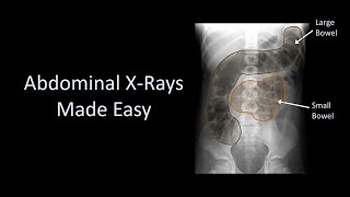 Abdominal XRays Made Easy [upl. by Aibos]