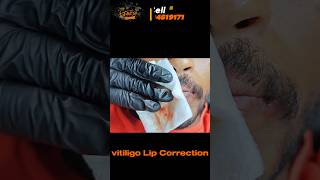 vitiligo lips vitiligo on lips causes treatments and useful tips white patches on lips [upl. by Judson971]