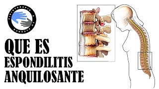 Espondilitis anquilosante que es y por que se produce [upl. by Annelise]