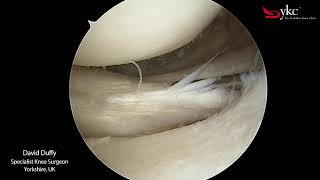 Watch a Knee Surgeon Treat a Meniscal Tear [upl. by Wyck]