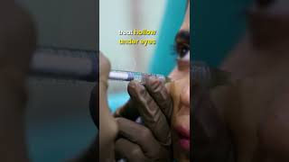 Dermal Fillers 💉🧏‍♀️ for Face lift Eyebrows and Scars  Dr Priyanka Reddy  DNA Skin Clinic [upl. by Baler]