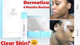 DERMATICA 4 MONTHS REVIEW  BEFORE amp AFTER amp SIDE EFFECTS [upl. by Thistle]