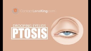 Drooping Eyelids  What causes Ptosis and How is it Treated [upl. by Aihsemat]