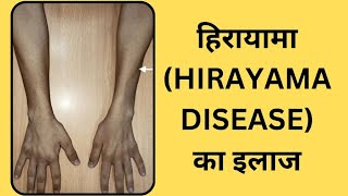 Hirayama Disease [upl. by Oriaj]