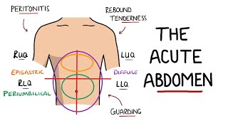 Acute Abdomen  A Guide to Acute Abdominal Pain [upl. by Ynnad63]