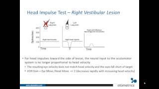 ICS Impulse vHIT Introduction and overview of underlying physiology [upl. by Mclaughlin135]