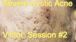 Severe Cystic Acne  Victor Session 2 [upl. by Thirza417]