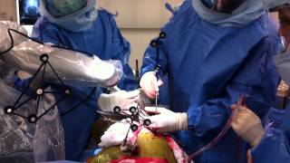 Mako robot for hip replacement [upl. by Shaper]