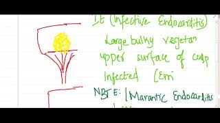 vegetations in endocarditis  Pathology [upl. by Kendrah]