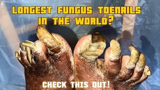 Extremely fungal thickened toenails I Onychogryphosis Transformation Trust Your Podiatrist [upl. by Nosna247]