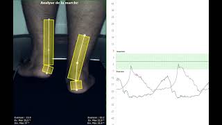 Analyse dun gros pied plat avec le logiciel postural Clinique OPS 3D [upl. by Mellisa]