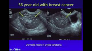 Adnexal Hemorrhagic Cyst  Ultrasound  Case 63 [upl. by Virgilio]