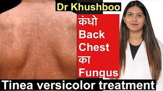 Tinea Versicolor Treatment  सेहुआ करोडियासीप Tinea body fungus treatment [upl. by Flossie]