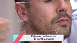 ¿Por que da la Parálisis facial [upl. by Warder]