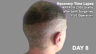 Hair Transplant Review 2013 19 DAY RECOVERY TIME LAPSE OF DONOR AREA POST OP [upl. by Oberg]