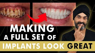 How we make a full set of Dental Implants all on 4 look great [upl. by Ivad]