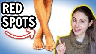 Why you get RED SPOTS ON THE LEGS amp HOW TO GET RID OF THEM  Dermatologist DrDrayzday [upl. by Adriane]