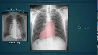 Situs Inversus with Dextrocardia Explanation of Chest Xray Findings [upl. by Nwahsan]