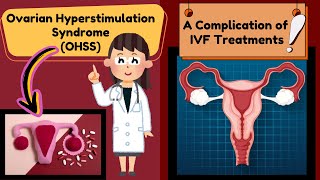 Ovarian Hyperstimulation Syndrome OHSS  A Complication of In Vitro Fertilization IVF Explained [upl. by Mareld]