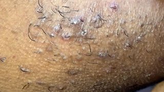 INGROWN HAIR REMOVAL 119 [upl. by Hoashis]