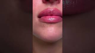 Looking for Best Lip Fillers and Enhancement Advice in Newcastle based Aesthetic Clinics LipGoals [upl. by Bastien]