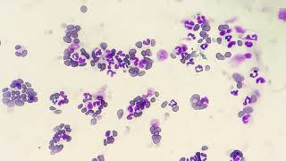 Neutrophilic Leukocytosis Blood smear examination [upl. by Jareen]