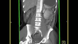 Abdomen Small Bowel Carcinoid tumor of the small bowel VRT images [upl. by Ellienad]