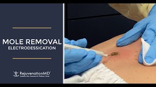 Electrodessication to Remove Seborrheic Keratosis [upl. by Highams]