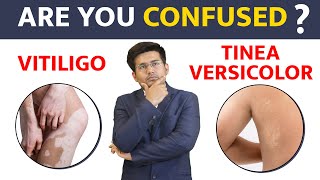 Is it Vitiligo or Tinea Versicolor  Bharat Homeopathy [upl. by Tallia]