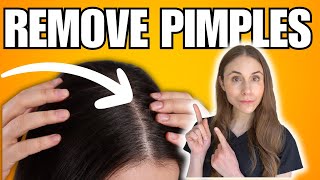 How To Remove Scalp Pimples  Folliculitis Explained [upl. by Whitten]