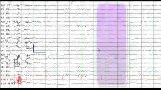 EEG Tutorial [upl. by Ati]