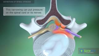 Spinal Stenosis Definition [upl. by Naux168]