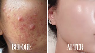 Get CLEAR SKIN subliminal  Get rid of acne in 10 minutes [upl. by Nolaj]