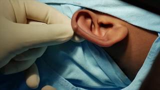 Small hard bump on ear Cartilage  Surgical Removal [upl. by Tserof]