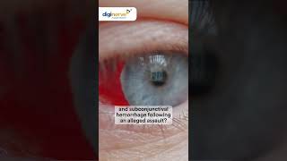 Identify patient’s condition presenting with orbital ecchymosis amp subconjunctival hemorrhage [upl. by Lleroj]