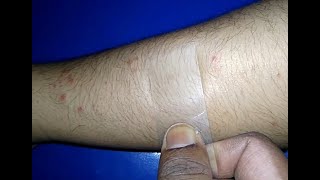 Diascopy Or Glass Test  Differentiate Erythematous or PurpuricPetichial lesion [upl. by Norina]