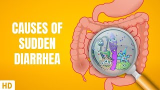 Causes of Sudden Diarrhea [upl. by Enidlareg]