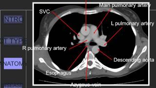 Approach to CT Chest 849 [upl. by Nyrahtak]