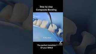 Teeth Composite bonding step by step [upl. by Denice]