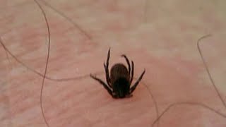 Tracking ticks Is that a tick bite [upl. by Ivon230]