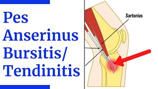 Pes Anserine BursitisTendinitis Evaluation [upl. by Ahsinotna514]