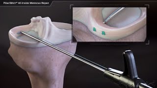 FiberStitch™ AllInside Meniscus Repair [upl. by Mimi]