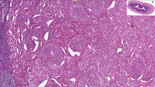 Neuroendocrine Tumors – An Introduction [upl. by Brenk762]