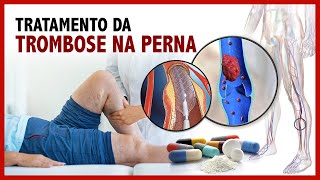 Tratamento da trombose na perna [upl. by Lovering599]