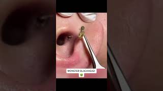 Is that a Giant Blackhead in Ear 😮🫣 [upl. by Anilys]